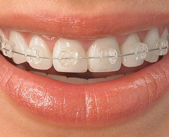 Conventional ceramic braces
