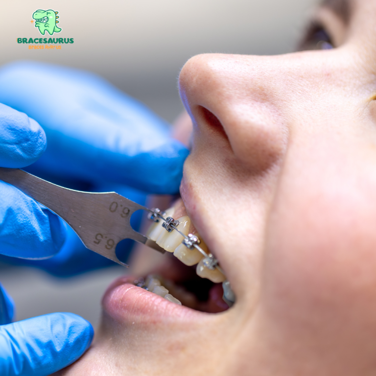 How Braces Function: All the Essential Information You Need