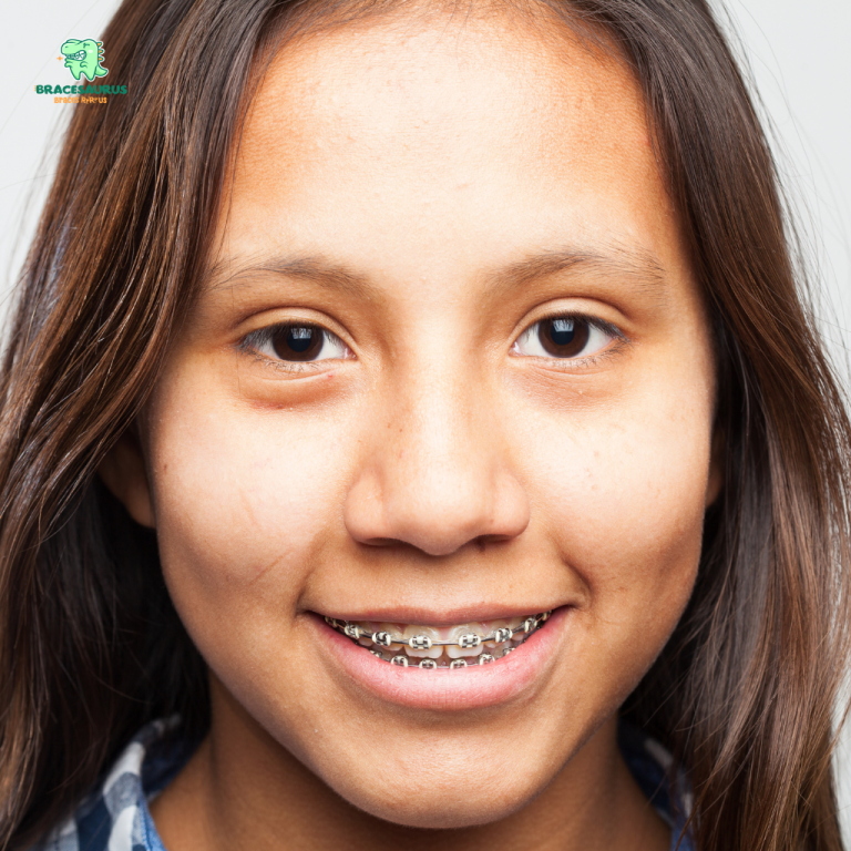 Teeth Braces in Singapore: Which Option Is Right for Your Smile?