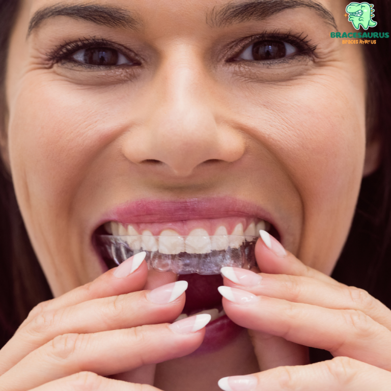 Invisible Braces Singapore: How to Clean and Maintain Your Aligners