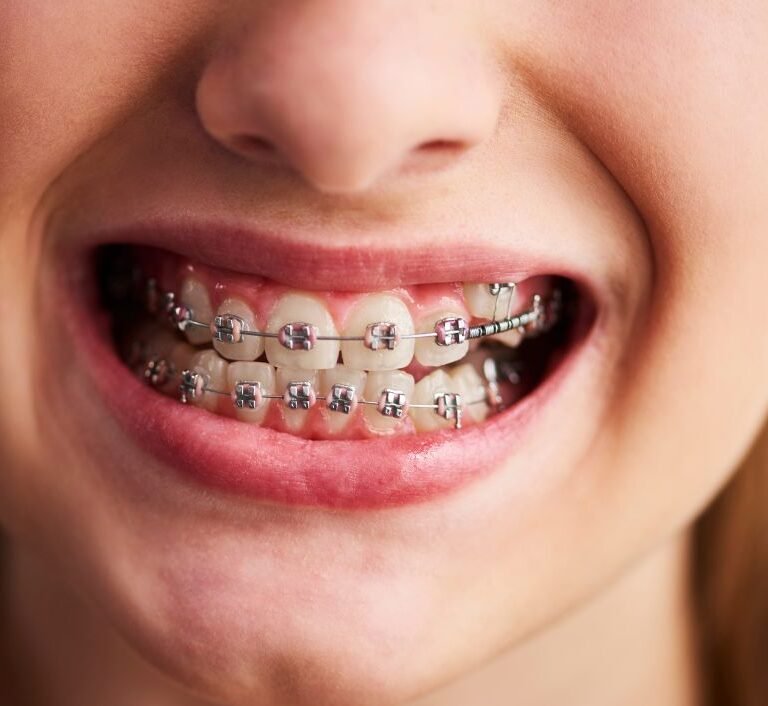 teeth braces