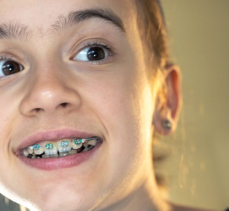 teeth braces in Singapore