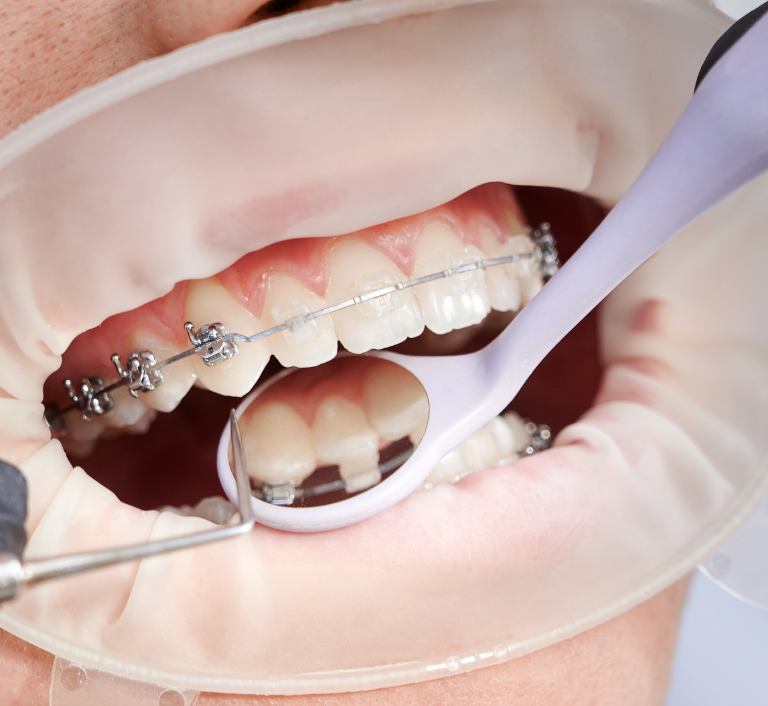 self ligating braces
