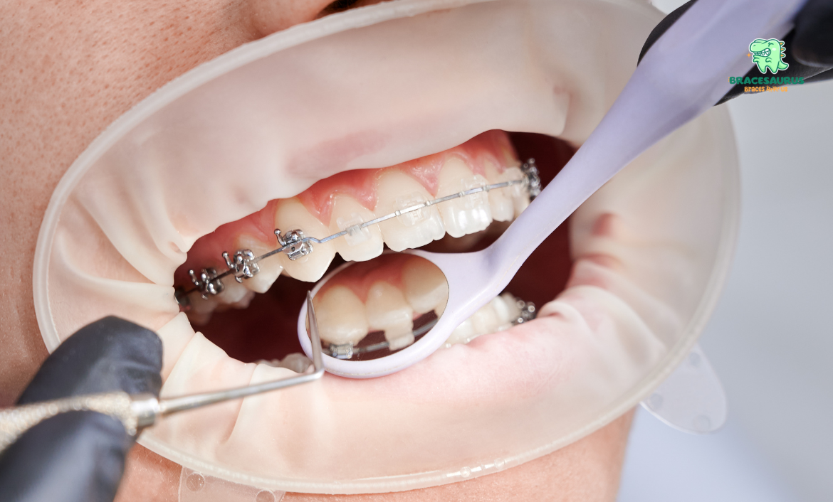 self ligating braces